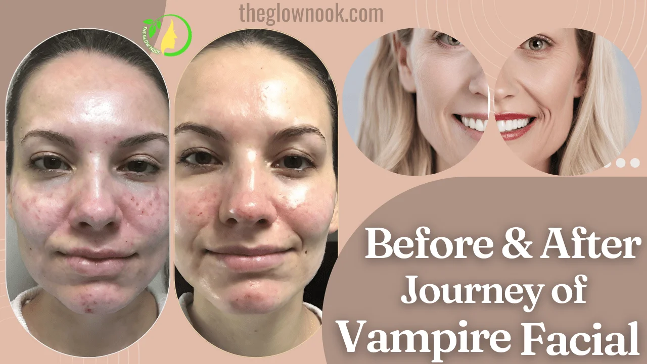 Before & After Journey of Vampire Facial