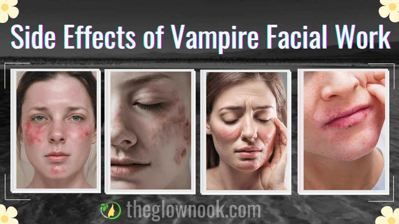 Side Effects of Vampire Facial Work
