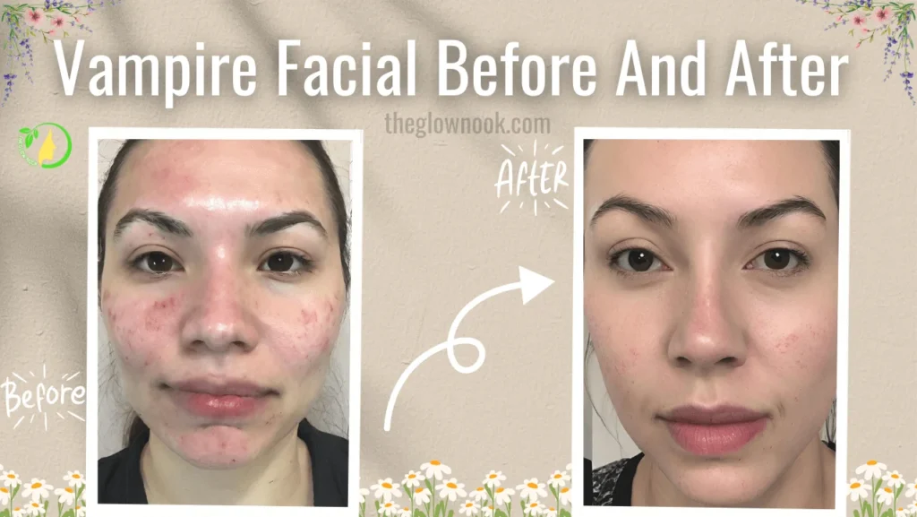 Vampire Facial Before and After (prp)