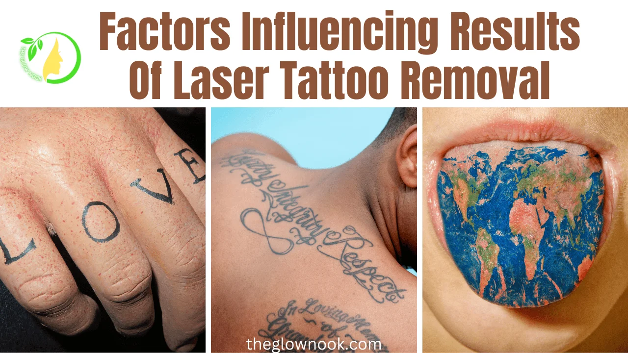 Factors Influencing Results Of Laser Tattoo Removal