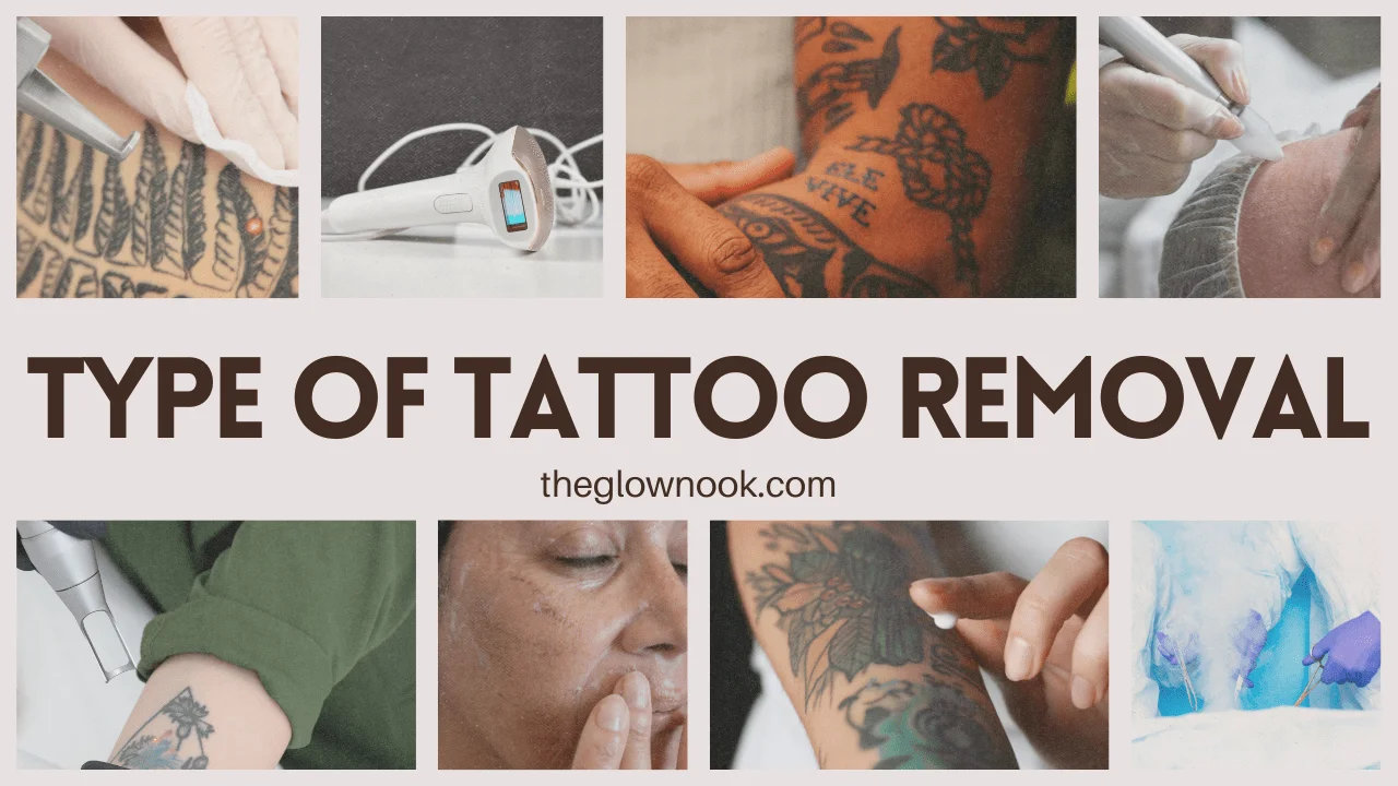 Type of Tattoo Removal